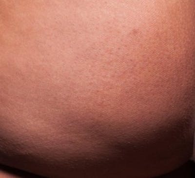 Cellfina Before & After Gallery - Patient 988700 - Image 2