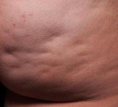 Cellfina Before & After Gallery - Patient 201421 - Image 1