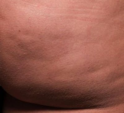 Cellfina Before & After Gallery - Patient 201421 - Image 2