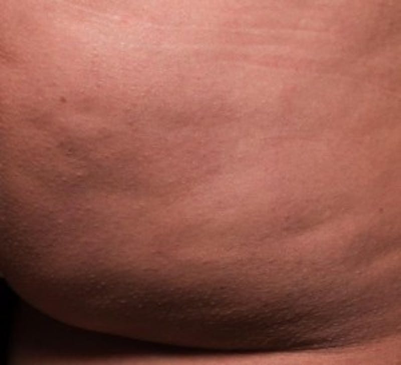 Cellfina Before & After Gallery - Patient 201421 - Image 2