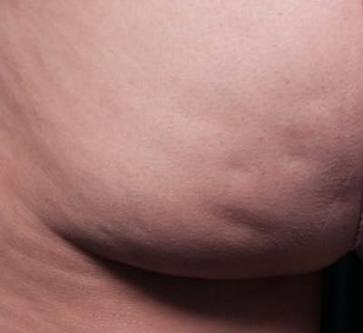 Cellfina Before & After Gallery - Patient 330009 - Image 1