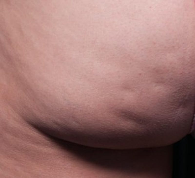 Cellfina Before & After Gallery - Patient 330009 - Image 1