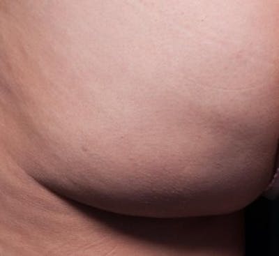 Cellfina Before & After Gallery - Patient 330009 - Image 2