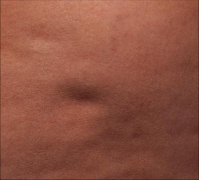 Cellfina Before & After Gallery - Patient 496922 - Image 1