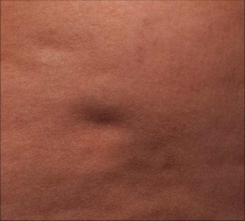 Cellfina Before & After Gallery - Patient 496922 - Image 1