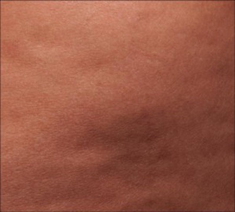 Cellfina Before & After Gallery - Patient 496922 - Image 2