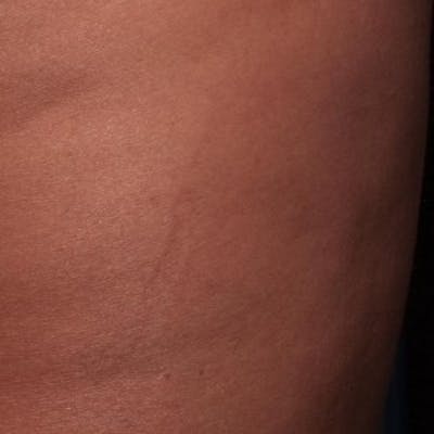 Cellfina Before & After Gallery - Patient 413943 - Image 1