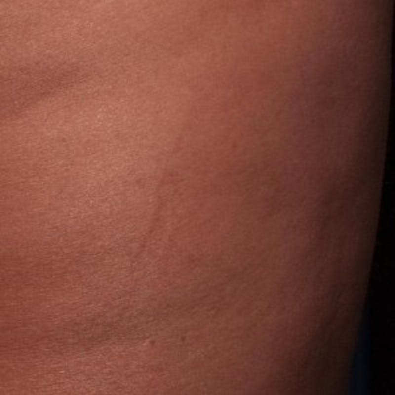 Cellfina Before & After Gallery - Patient 413943 - Image 1