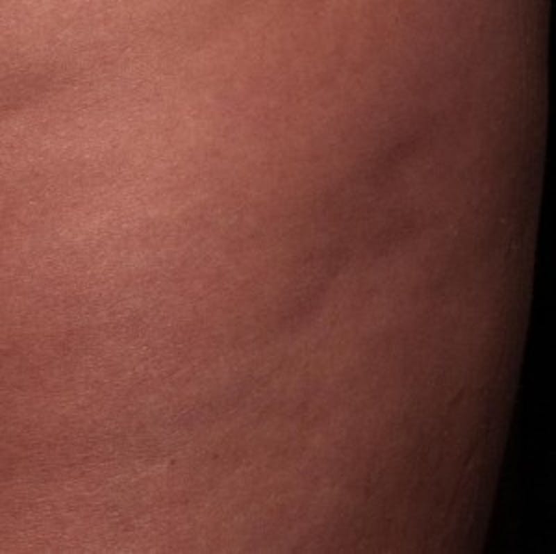 Cellfina Before & After Gallery - Patient 413943 - Image 2