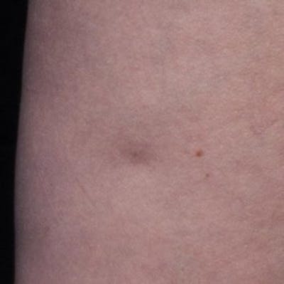 Cellfina Before & After Gallery - Patient 111248 - Image 1