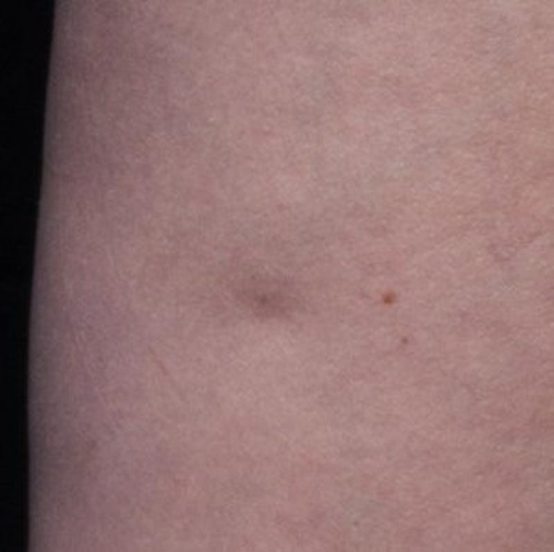 Cellfina Before & After Gallery - Patient 111248 - Image 1