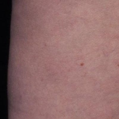 Cellfina Before & After Gallery - Patient 111248 - Image 2