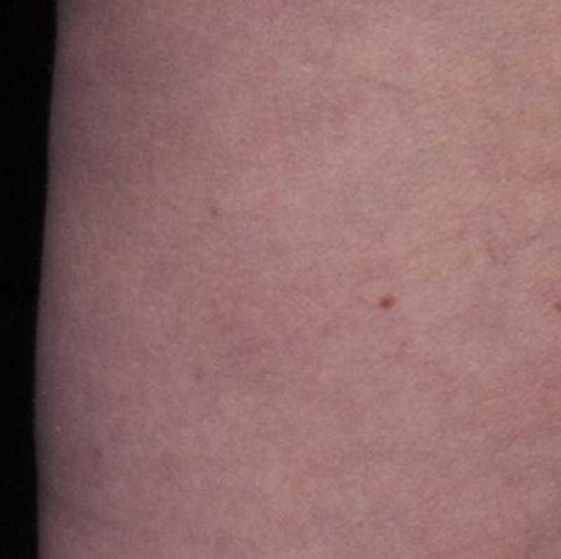 Cellfina Before & After Gallery - Patient 111248 - Image 2