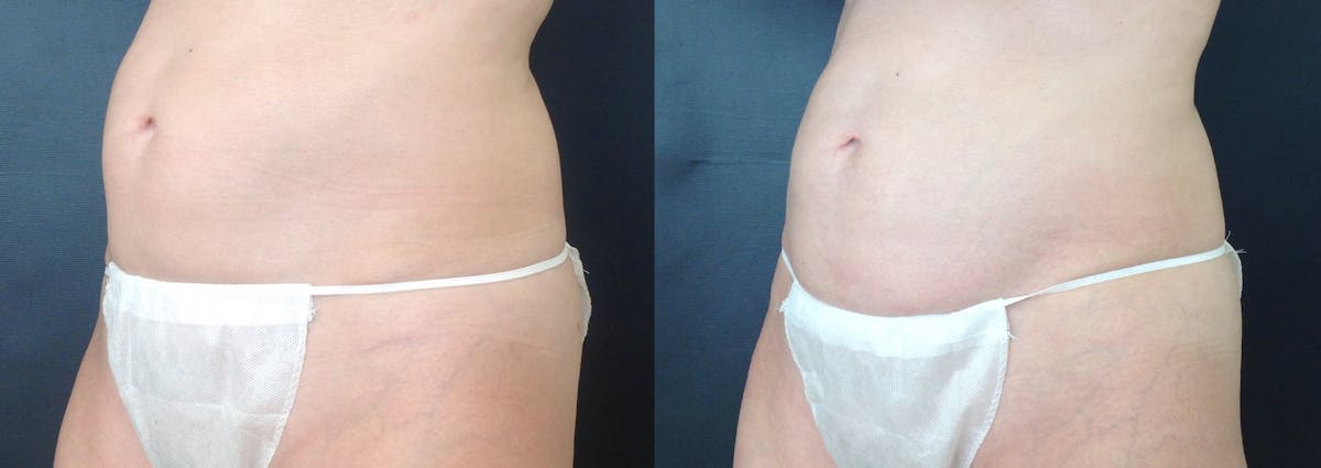 Coolsculpting Before & After Gallery - Patient 140550 - Image 1
