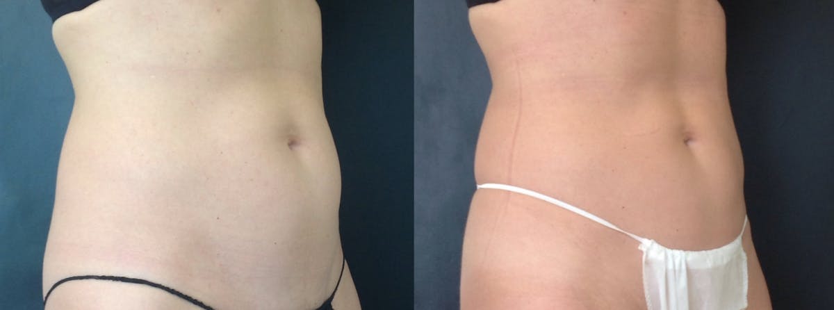 Coolsculpting Before & After Gallery - Patient 208870 - Image 1