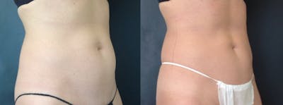 Coolsculpting Before & After Gallery - Patient 208870 - Image 1