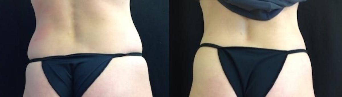 Coolsculpting Before & After Gallery - Patient 260202 - Image 1