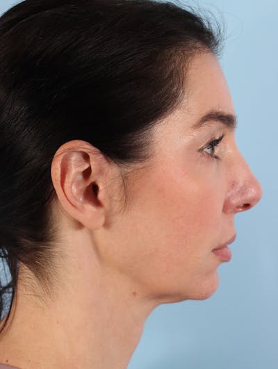 Coolsculpting Before & After Gallery - Patient 923206 - Image 2