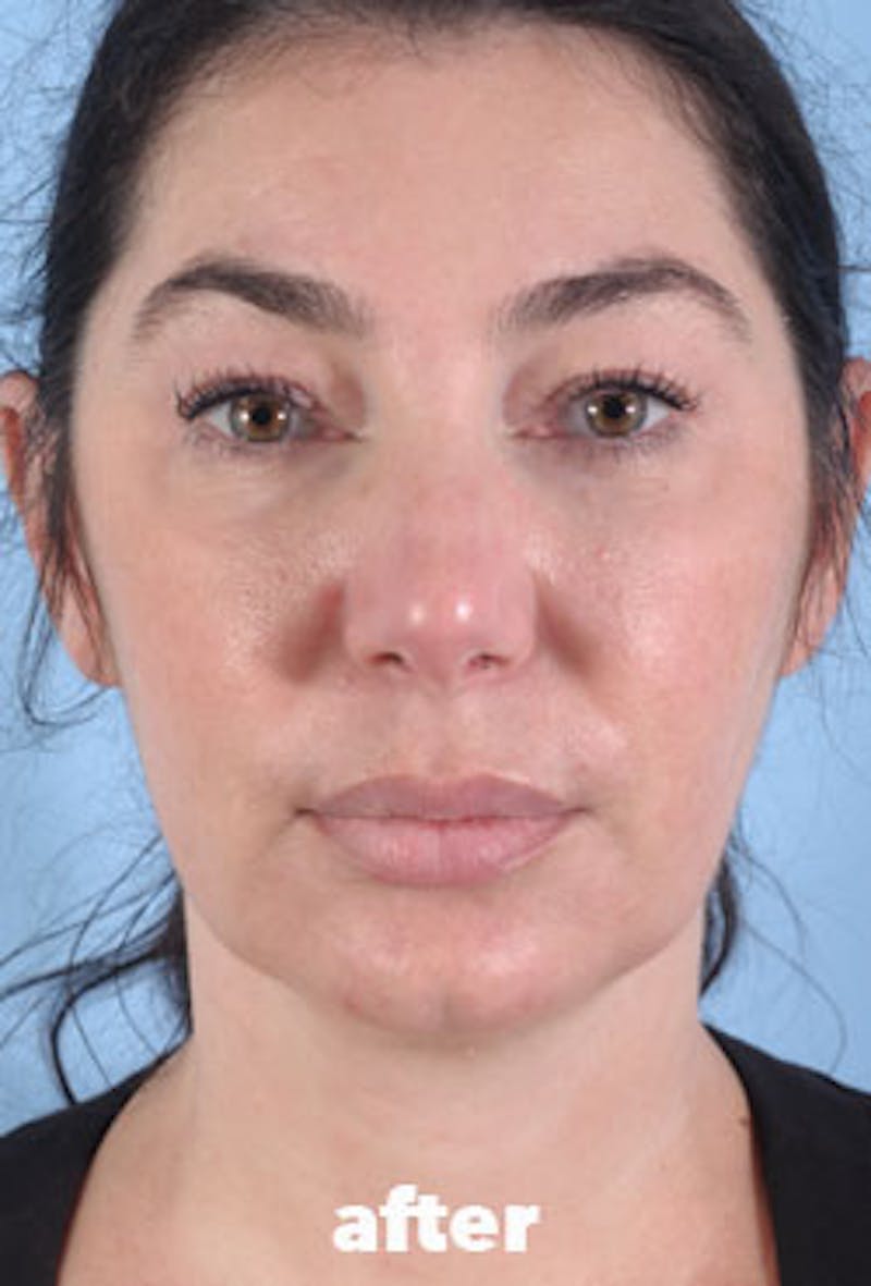 Coolsculpting Before & After Gallery - Patient 923206 - Image 4