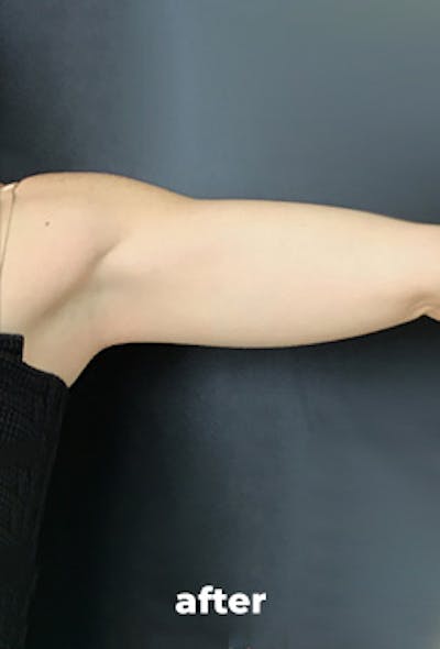 Coolsculpting Before & After Gallery - Patient 201289 - Image 2