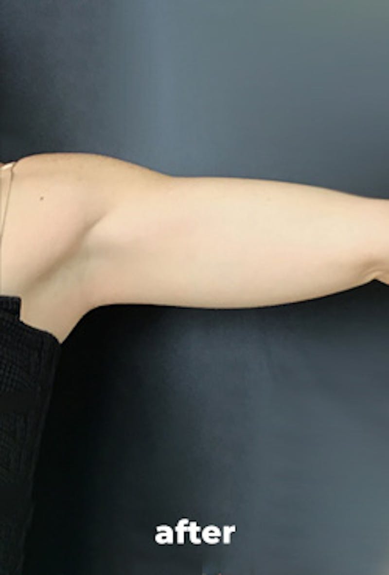 Coolsculpting Before & After Gallery - Patient 201289 - Image 2