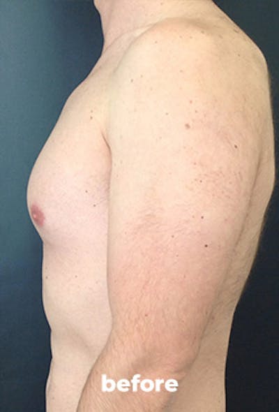 Coolsculpting Before & After Gallery - Patient 355046 - Image 1