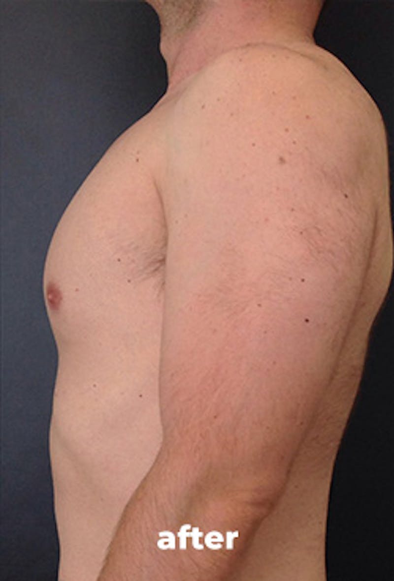 Coolsculpting Before & After Gallery - Patient 355046 - Image 2