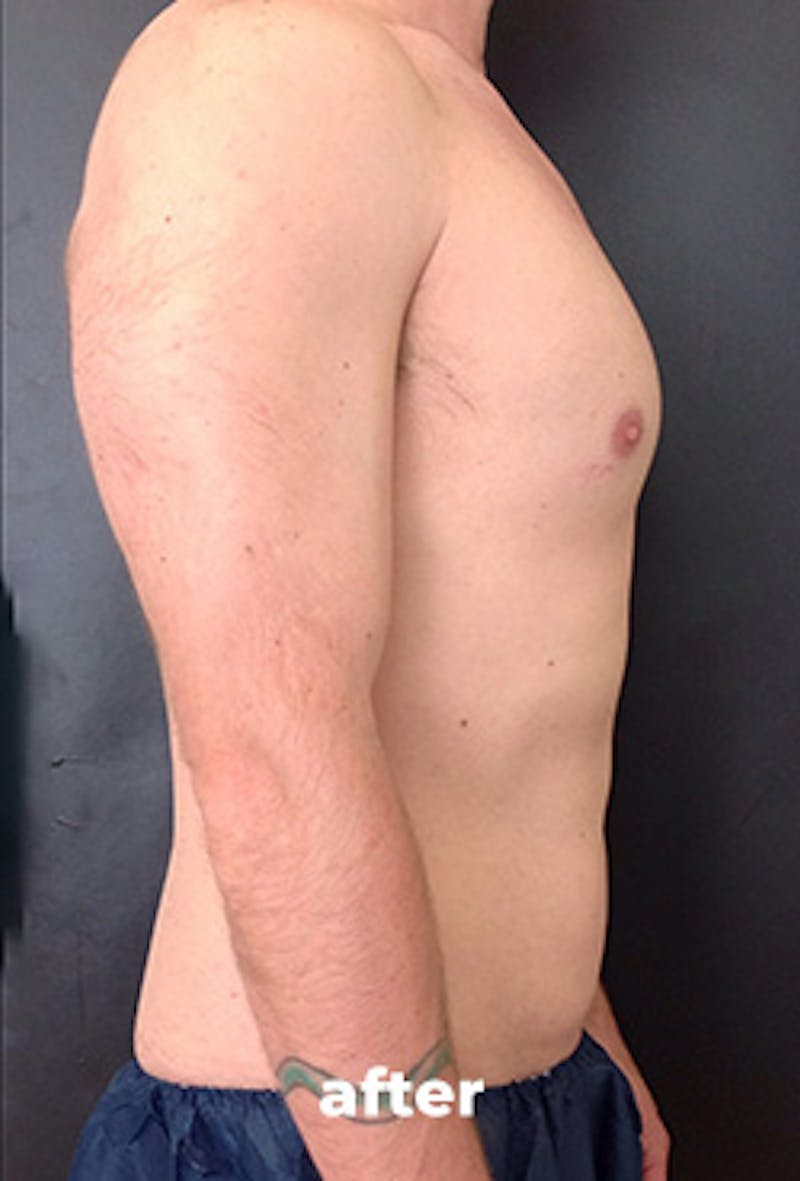 Coolsculpting Before & After Gallery - Patient 355046 - Image 4