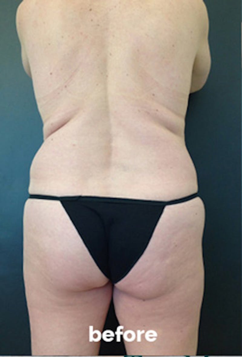 Coolsculpting Before & After Gallery - Patient 417508 - Image 1