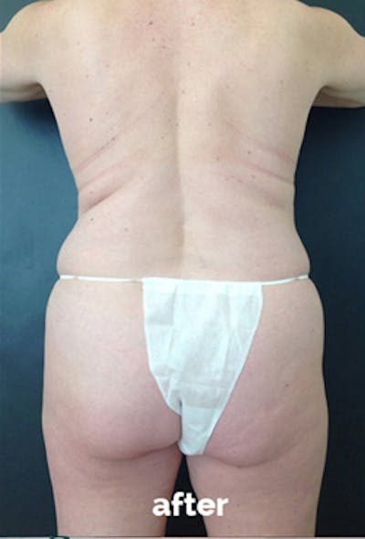 Coolsculpting Before & After Gallery - Patient 417508 - Image 2