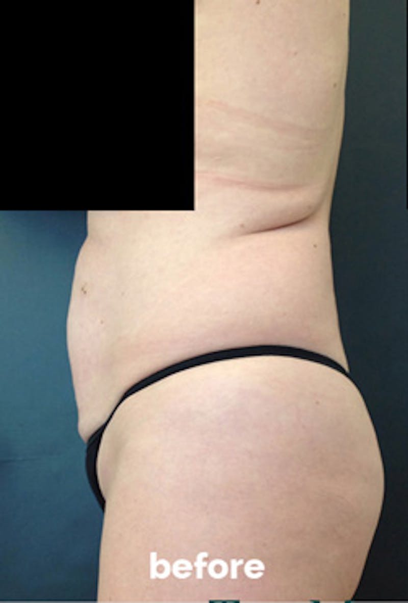 Coolsculpting Before & After Gallery - Patient 417508 - Image 3