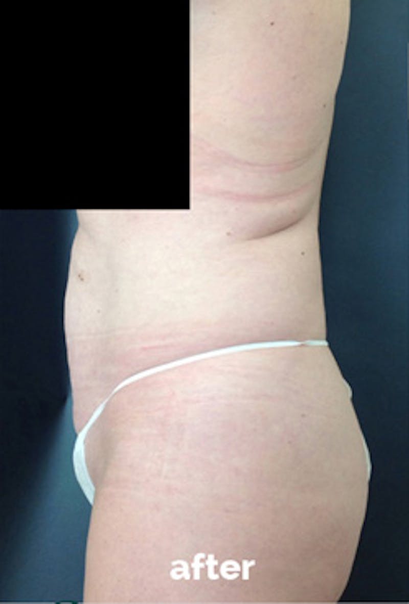 Coolsculpting Before & After Gallery - Patient 417508 - Image 4