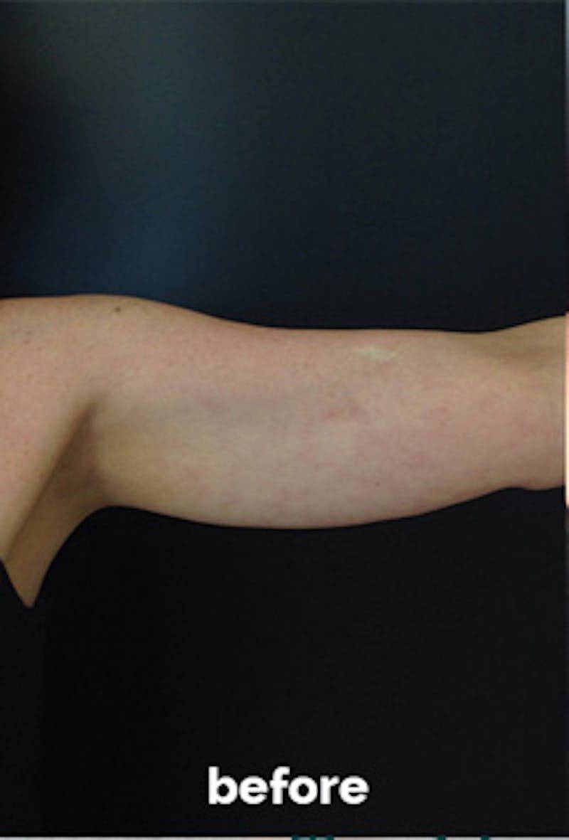 Coolsculpting Before & After Gallery - Patient 410358 - Image 1