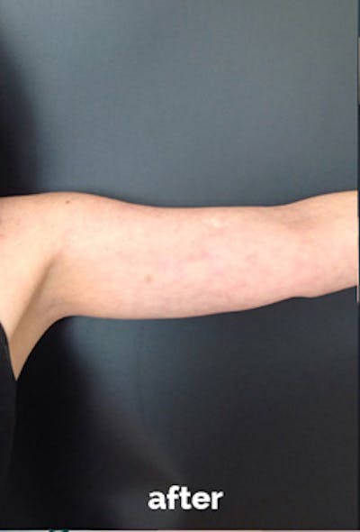Coolsculpting Before & After Gallery - Patient 410358 - Image 2