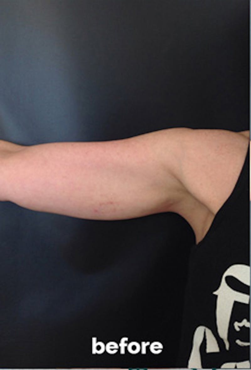 Coolsculpting Before & After Gallery - Patient 410358 - Image 3