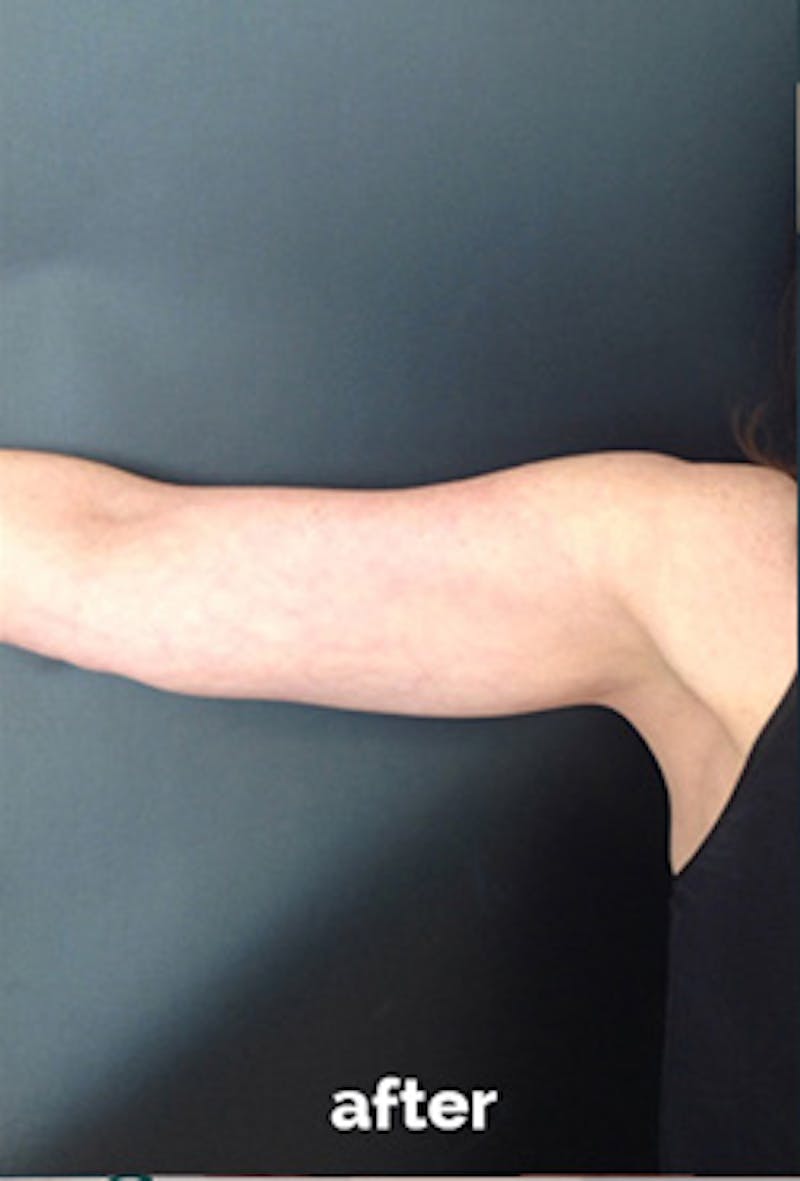 Coolsculpting Before & After Gallery - Patient 410358 - Image 4