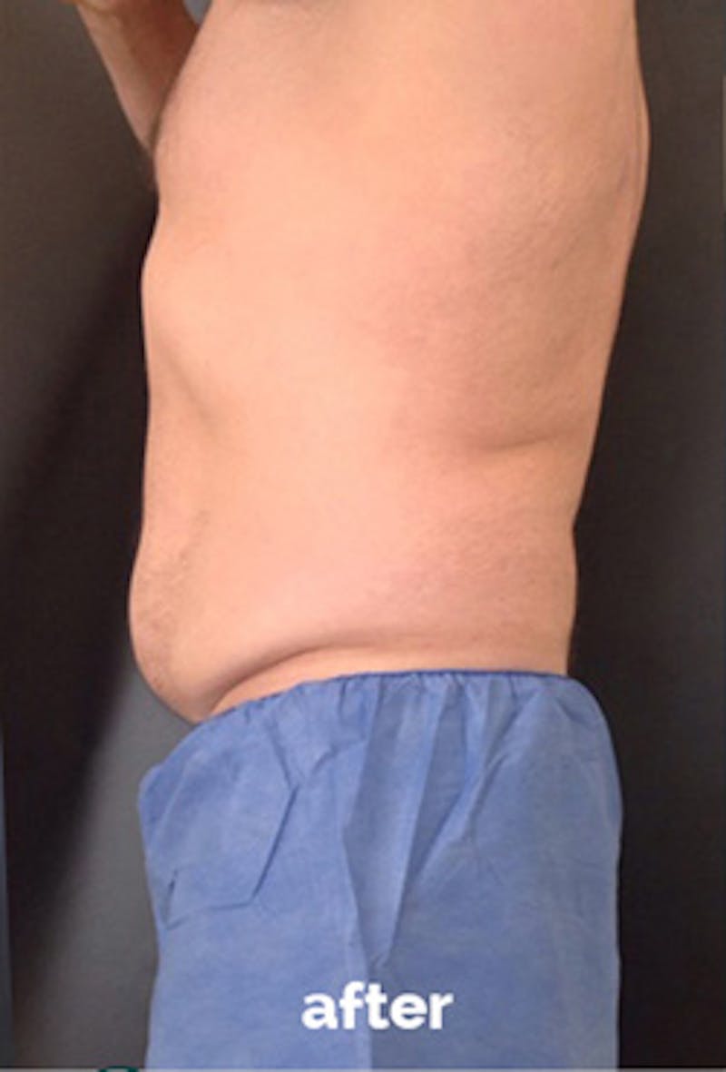 Coolsculpting Before & After Gallery - Patient 217574 - Image 4