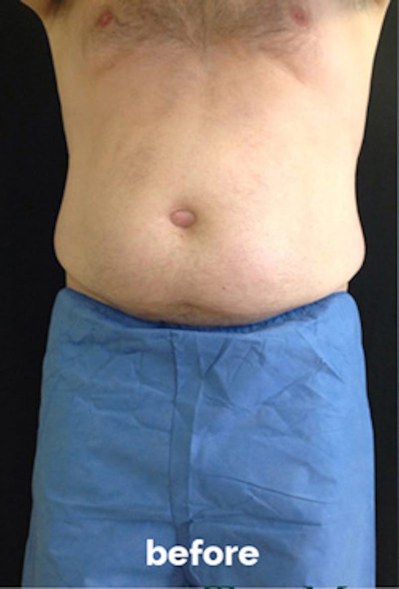 Coolsculpting Before & After Gallery - Patient 217574 - Image 5