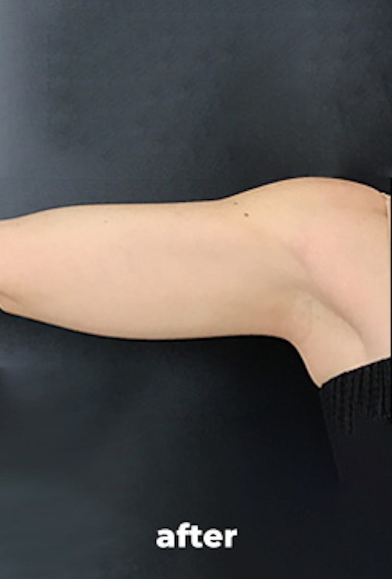 Coolsculpting Before & After Gallery - Patient 316031 - Image 2