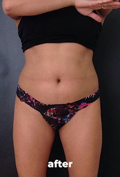 Coolsculpting Before & After Gallery - Patient 337180 - Image 2