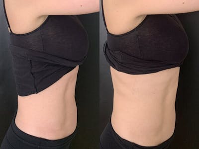 CoolTone Before & After Gallery - Patient 162609 - Image 1