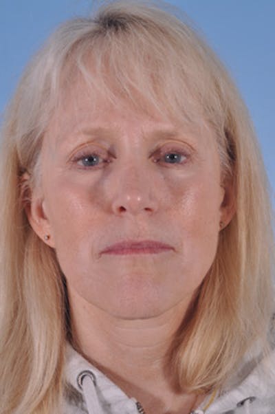 Facial Resurfacing Before & After Gallery - Patient 195754 - Image 1