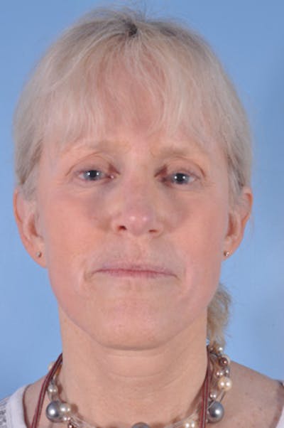 Facial Resurfacing Before & After Gallery - Patient 195754 - Image 2