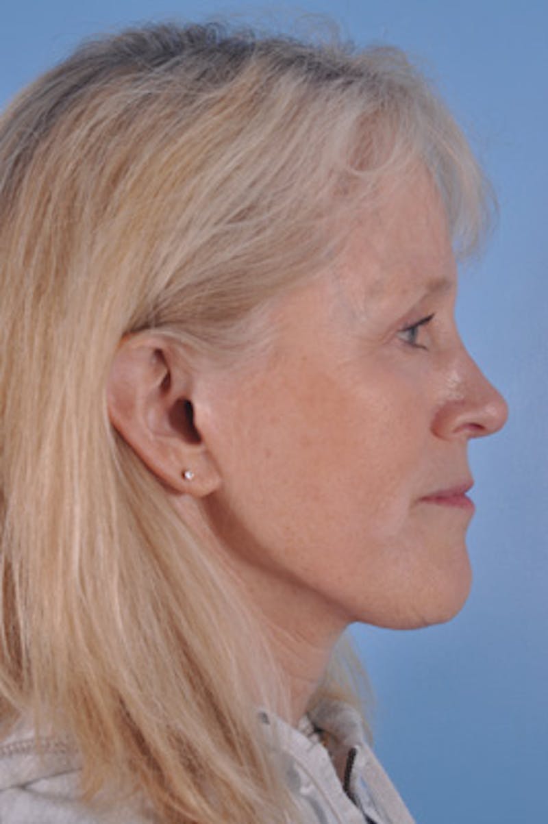 Facial Resurfacing Before & After Gallery - Patient 195754 - Image 3
