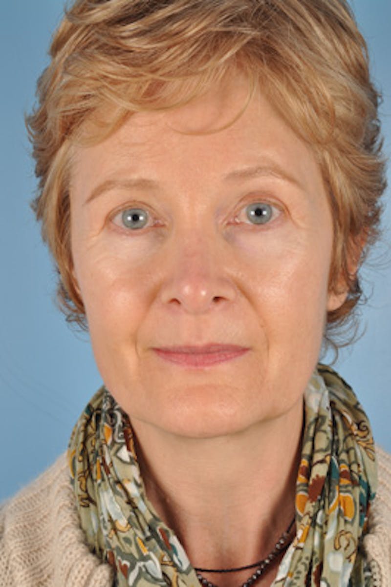 Facial Resurfacing Before & After Gallery - Patient 115394 - Image 2