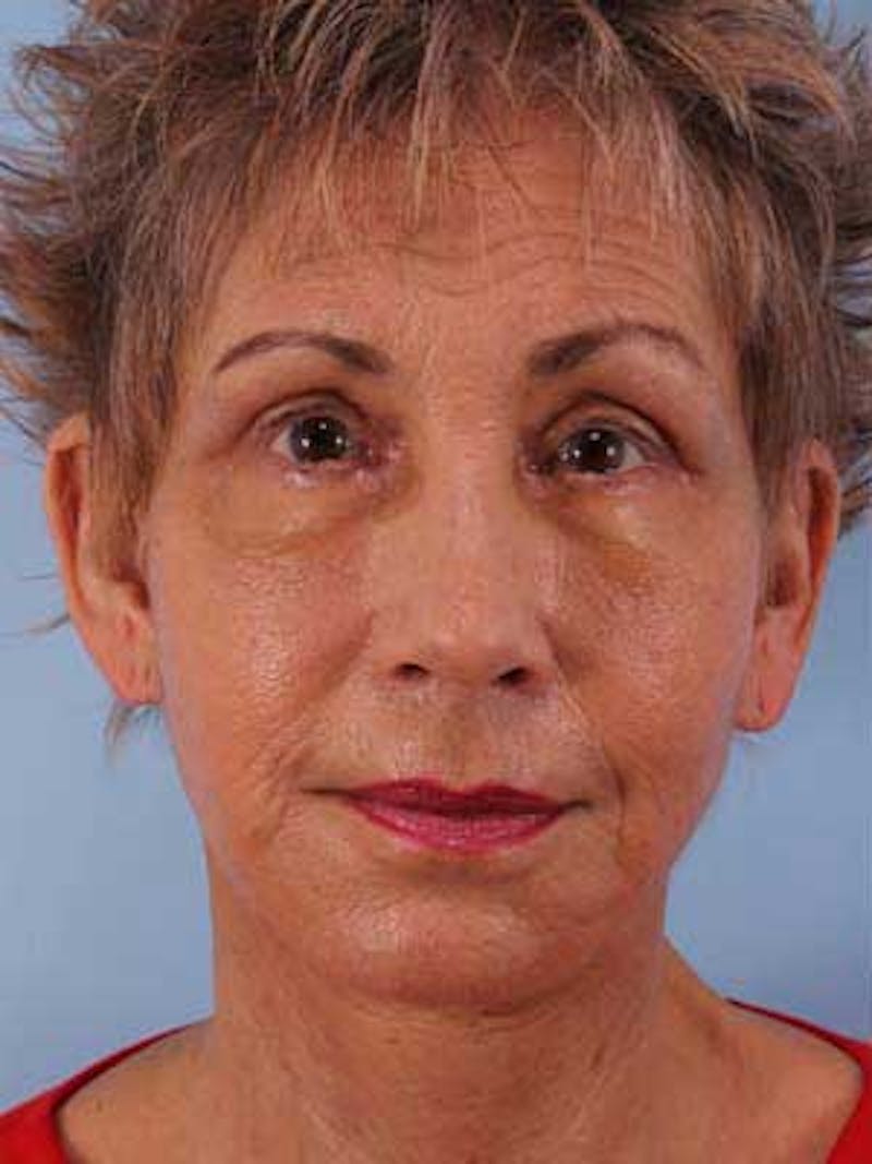 Facial Resurfacing Before & After Gallery - Patient 208075 - Image 1
