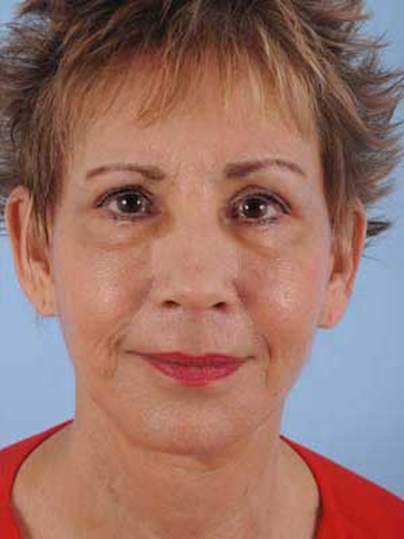 Facial Resurfacing Before & After Gallery - Patient 208075 - Image 2