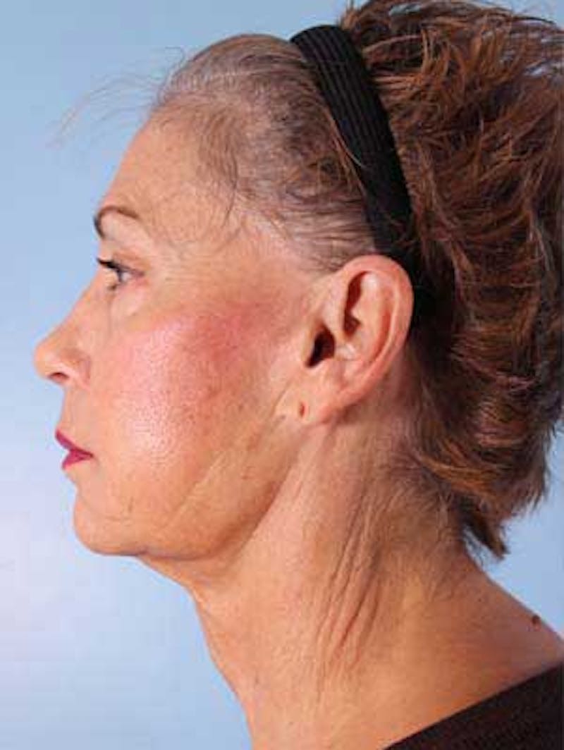 Facial Resurfacing Before & After Gallery - Patient 208075 - Image 3