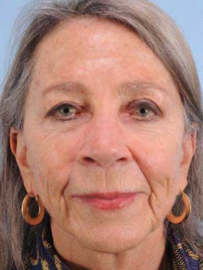 Facial Resurfacing Before & After Gallery - Patient 339700 - Image 1