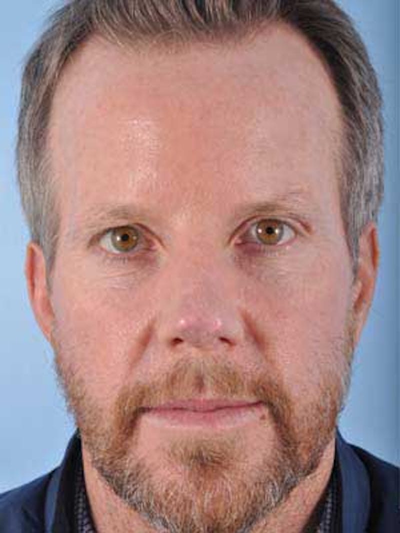 Facial Resurfacing Before & After Gallery - Patient 185325 - Image 1